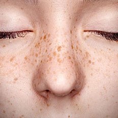 Freckles